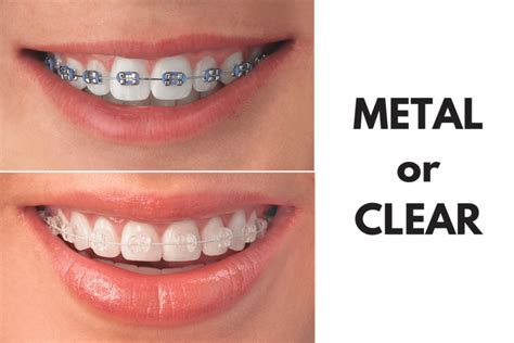 clear brackets with metal wire|clear braces vs metal.